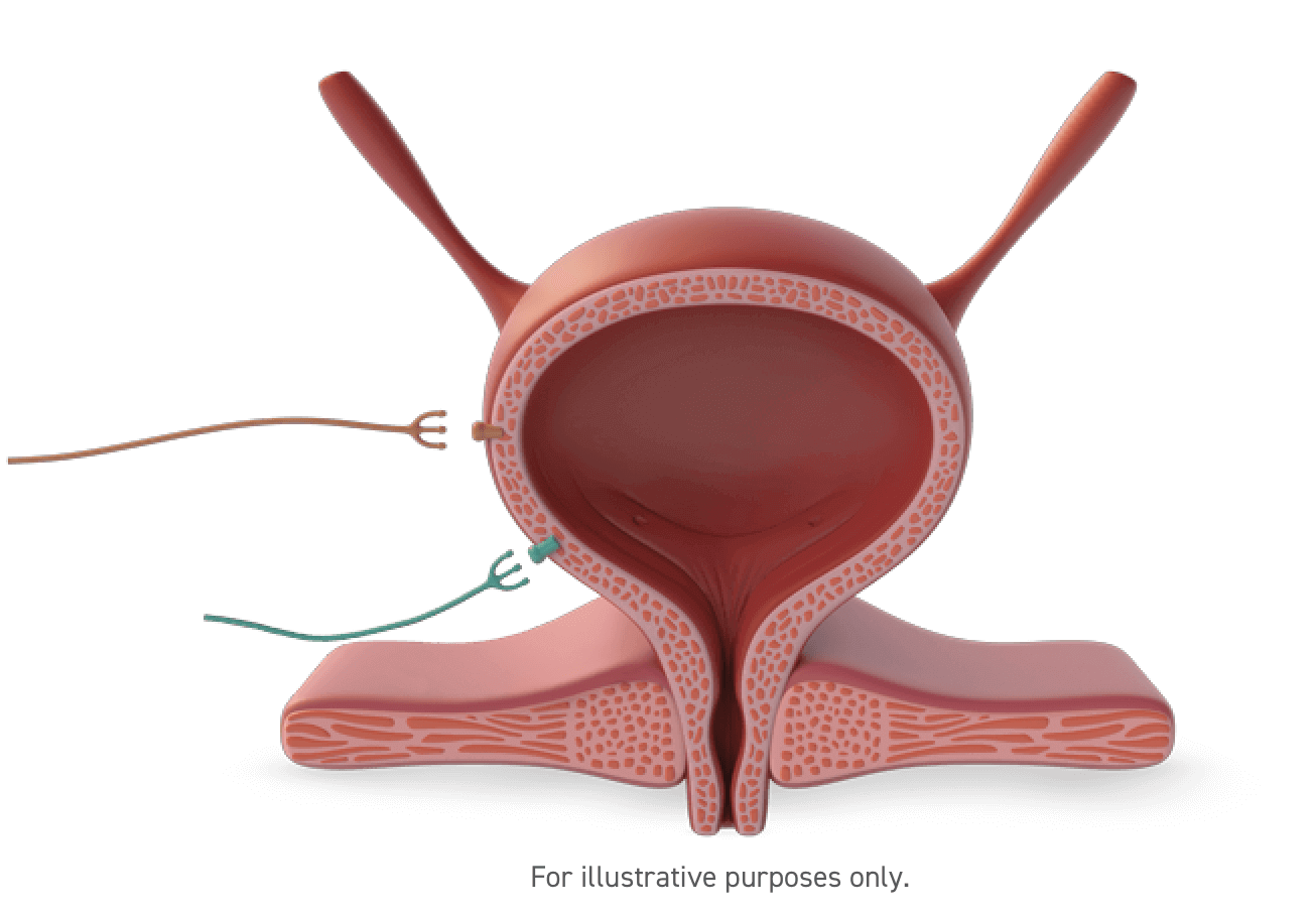 Diagram of a bladder. GEMTESA® activates the beta-3 adrenergic receptor, relaxing the bladder detrusor muscle.